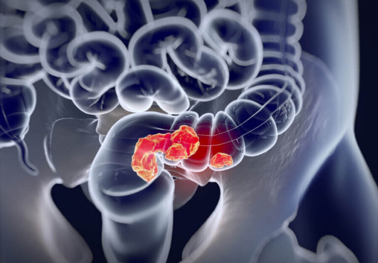 Colorectal image of example patient